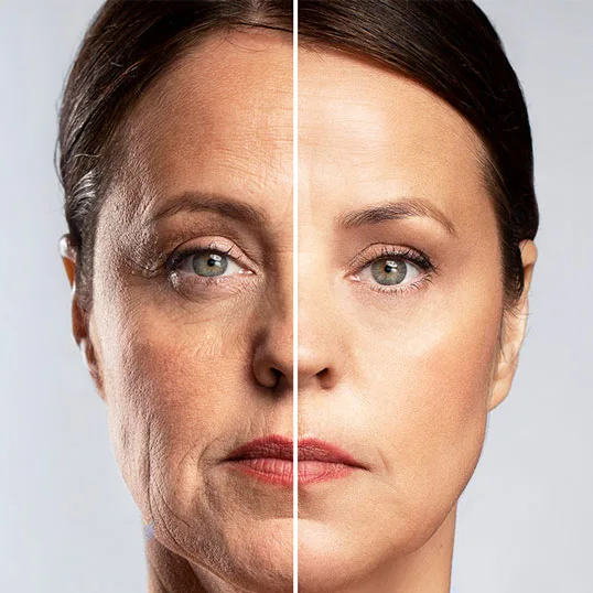 Vorher Nachher RF- und Microneedling Hautverfeinerung Essen