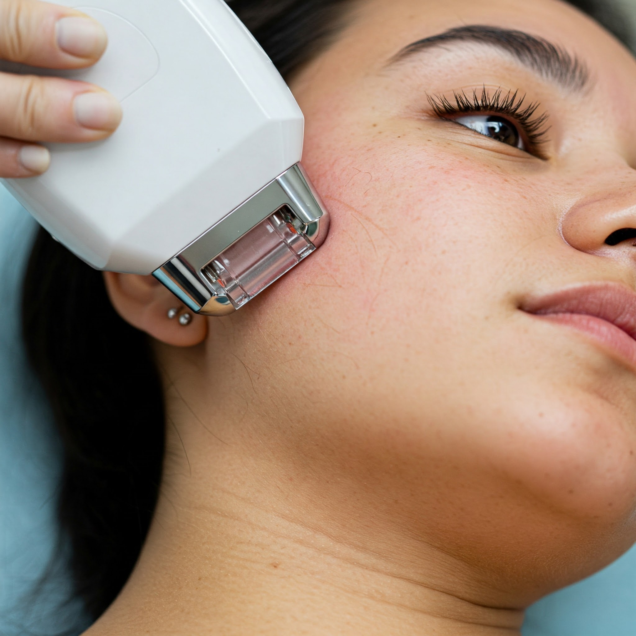 Gesichtshaarentfernung mit Diodenlaser