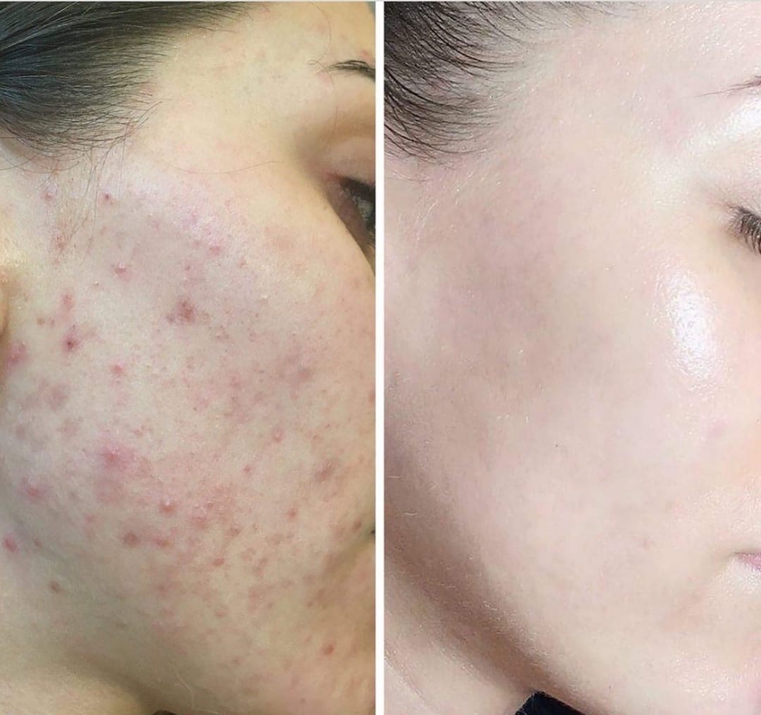 Vorher Nachher CO2 Laser Aknebehandlung Hauterneuerung Essen
