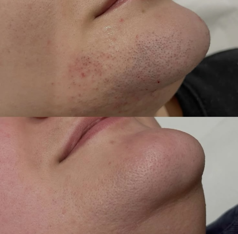 Vorher Nachher Kinnbereich dauerhafte Haarentfernung Diodenlaser Essen